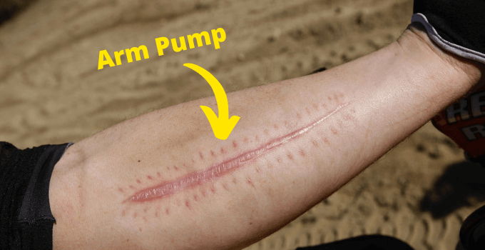 Best Tips To Prevent Dirt Bike Arm Pumps